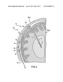 VENTRICULAR SHUNT SYSTEM AND METHOD diagram and image