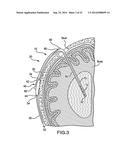 VENTRICULAR SHUNT SYSTEM AND METHOD diagram and image