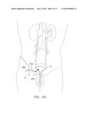Rotate-to-Advance Catheterization System diagram and image