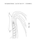 Rotate-to-Advance Catheterization System diagram and image