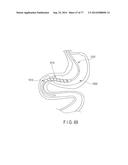 Rotate-to-Advance Catheterization System diagram and image