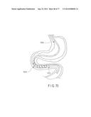 Rotate-to-Advance Catheterization System diagram and image