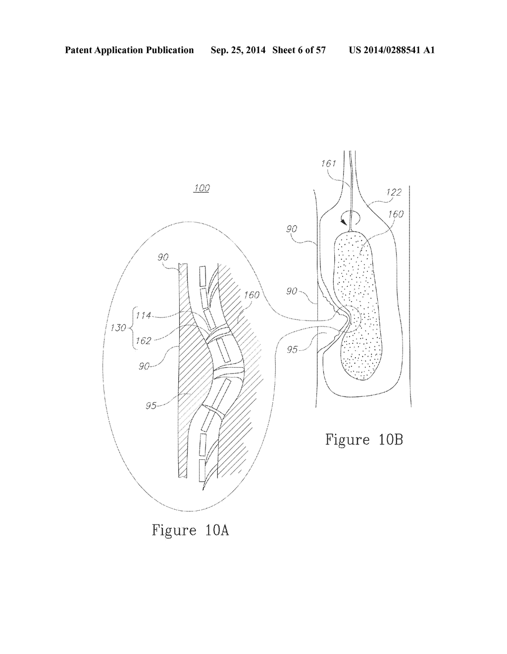 LESION TREATMENT DEVICE AND METHODS FOR TREATING LESIONS - diagram, schematic, and image 07