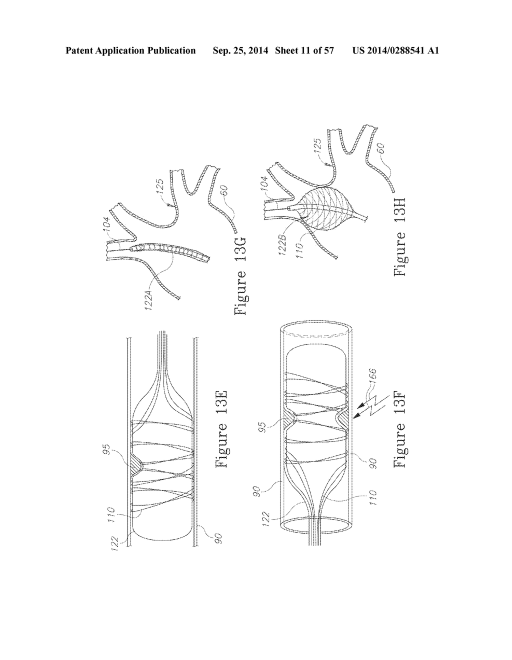LESION TREATMENT DEVICE AND METHODS FOR TREATING LESIONS - diagram, schematic, and image 12