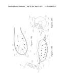 LESION TREATMENT DEVICE AND METHODS FOR TREATING LESIONS diagram and image