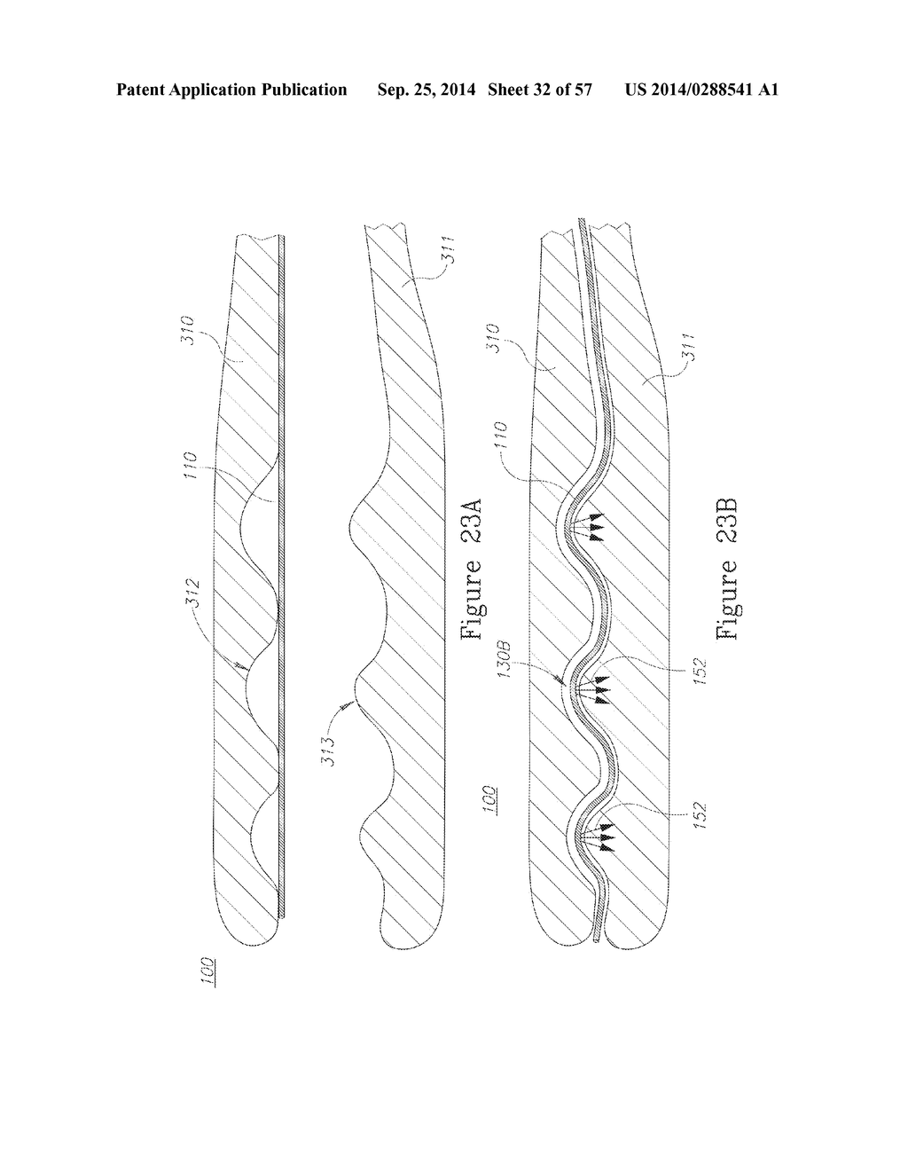 LESION TREATMENT DEVICE AND METHODS FOR TREATING LESIONS - diagram, schematic, and image 33