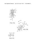 CARDIAC ABLATION SYSTEMS AND METHODS diagram and image