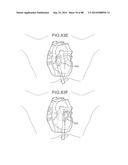 CARDIAC ABLATION SYSTEMS AND METHODS diagram and image