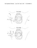 CARDIAC ABLATION SYSTEMS AND METHODS diagram and image