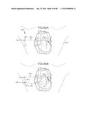 CARDIAC ABLATION SYSTEMS AND METHODS diagram and image