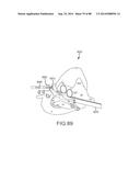 CARDIAC ABLATION SYSTEMS AND METHODS diagram and image