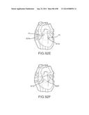 CARDIAC ABLATION SYSTEMS AND METHODS diagram and image