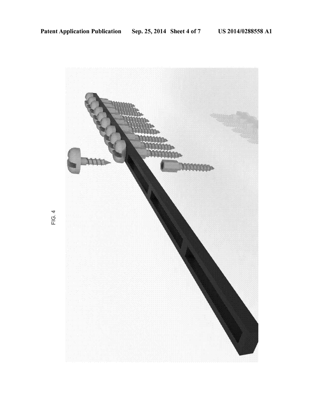 Flexible Rail Bar Bone Fixation System - diagram, schematic, and image 05