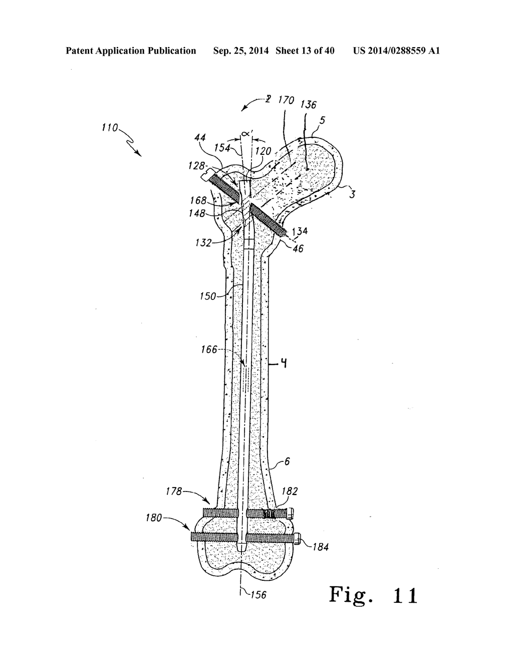 Intramedullary Nail With Oblique Openings - diagram, schematic, and image 14