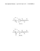 Apparatus and Methods for Treating Hardened Vascular Lessions diagram and image