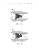 Intravascular Filter With Debris Entrapment Mechanism diagram and image