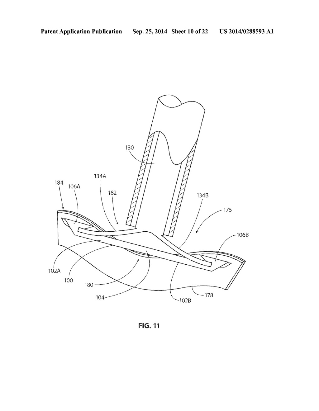 METHODS AND APPARATUS HAVING BOWSTRING-LIKE STAPLE DELIVERY TO A TARGET     TISSUE - diagram, schematic, and image 11