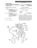 IMPLANTS FOR SPINAL FIXATION OR FUSION diagram and image
