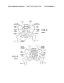 IMPLANTS FOR SPINAL FIXATION OR FUSION diagram and image