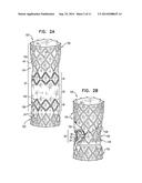 TRIPLE-COLLAR STENT-GRAFT diagram and image