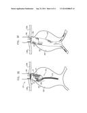 TRIPLE-COLLAR STENT-GRAFT diagram and image