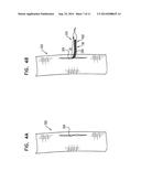 TRIPLE-COLLAR STENT-GRAFT diagram and image