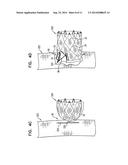 TRIPLE-COLLAR STENT-GRAFT diagram and image