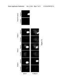 COMPOSITIONS AND METHODS FOR DIAGNOSING AND MONITORING OVARIAN CANCER     PROGRESSION AND TREATMENT diagram and image