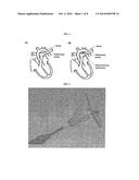 OCCLUSION DEVICE FOR CLOSING ANATOMICAL DEFECTS diagram and image