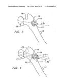 Bone end (epiphysis) fracture fixation device and method of use diagram and image