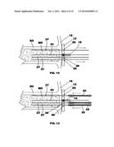 Bone end (epiphysis) fracture fixation device and method of use diagram and image