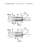 Bone end (epiphysis) fracture fixation device and method of use diagram and image