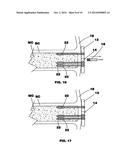 Bone end (epiphysis) fracture fixation device and method of use diagram and image