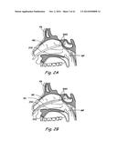 DEVICES, SYSTEMS AND METHODS USEABLE FOR TREATING SINUSITIS diagram and image