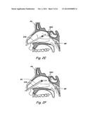 DEVICES, SYSTEMS AND METHODS USEABLE FOR TREATING SINUSITIS diagram and image