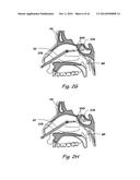 DEVICES, SYSTEMS AND METHODS USEABLE FOR TREATING SINUSITIS diagram and image