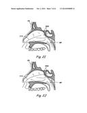 DEVICES, SYSTEMS AND METHODS USEABLE FOR TREATING SINUSITIS diagram and image