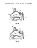 DEVICES, SYSTEMS AND METHODS USEABLE FOR TREATING SINUSITIS diagram and image