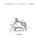 DEVICES, SYSTEMS AND METHODS USEABLE FOR TREATING SINUSITIS diagram and image