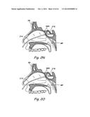 DEVICES, SYSTEMS AND METHODS USEABLE FOR TREATING SINUSITIS diagram and image