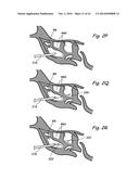 DEVICES, SYSTEMS AND METHODS USEABLE FOR TREATING SINUSITIS diagram and image