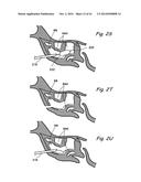 DEVICES, SYSTEMS AND METHODS USEABLE FOR TREATING SINUSITIS diagram and image