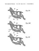 DEVICES, SYSTEMS AND METHODS USEABLE FOR TREATING SINUSITIS diagram and image