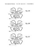 DEVICES, SYSTEMS AND METHODS USEABLE FOR TREATING SINUSITIS diagram and image