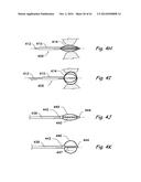 DEVICES, SYSTEMS AND METHODS USEABLE FOR TREATING SINUSITIS diagram and image