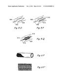 DEVICES, SYSTEMS AND METHODS USEABLE FOR TREATING SINUSITIS diagram and image