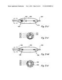 DEVICES, SYSTEMS AND METHODS USEABLE FOR TREATING SINUSITIS diagram and image