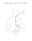 METHODS AND DEVICES FOR DEPLOYING AND RELEASING A TEMPORARY IMPLANT WITHIN     THE BODY diagram and image