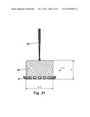 Medical Implant, A Kit And A Method Of Manufacturing A 3D Fabric Of     Strands For Forming A Medical Implant diagram and image