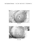 Tissure Closure Device and Method diagram and image